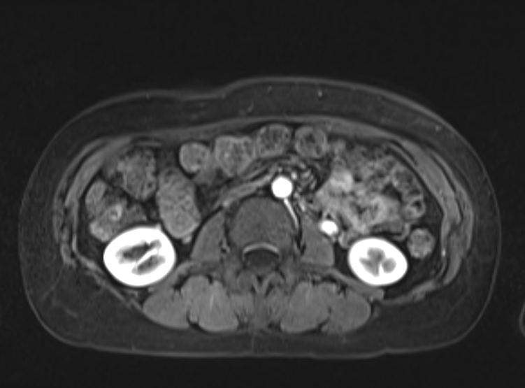 Acute pancreatitis - Balthazar E - post ERCP (Radiopaedia 27562-27778 Axial VIBE C+ 65).png