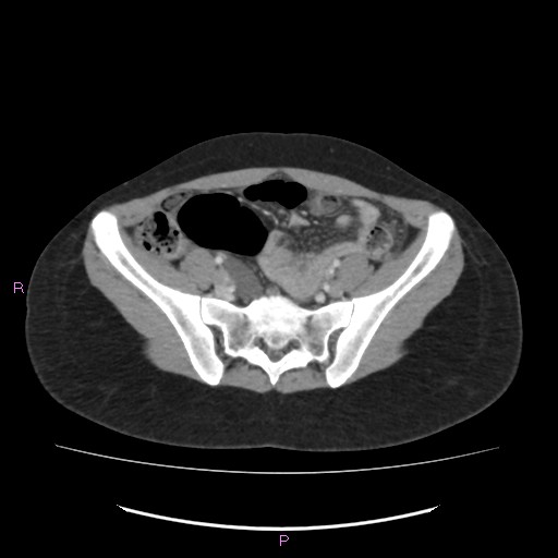 Acute pancreatitis secondary to stone at minor papilla and pancreatic divisum (Radiopaedia 76570-88333 Axial C+ portal venous phase 59).jpg