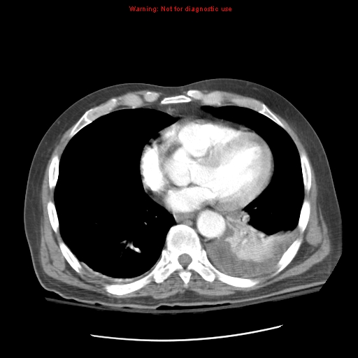 File:Acute pancreatitis with incidental pancreatic lipoma (Radiopaedia 10190-10730 Axial C+ arterial phase 6).jpg