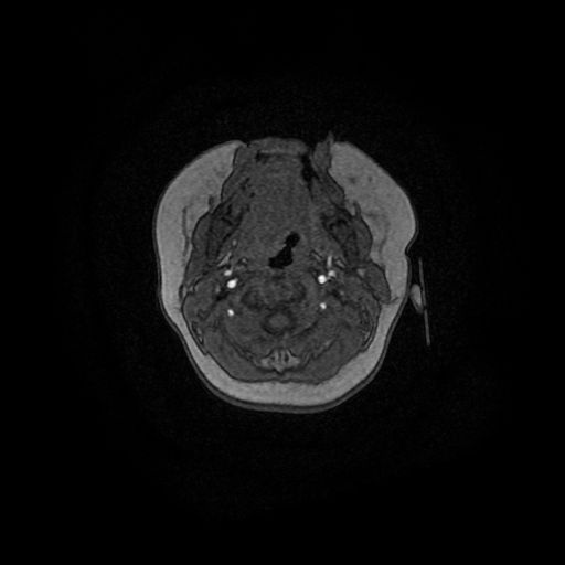 File:Acute phase of hemiconvulsion-hemiplegia epilepsy syndrome (Radiopaedia 29309-29745 Axial TOF angiography 174).jpg
