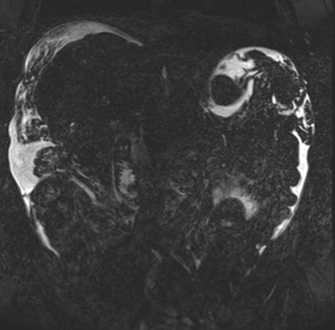 Acute portal vein thrombosis (Radiopaedia 73198-83925 Coronal Heavily T2 thin cuts 47).jpg
