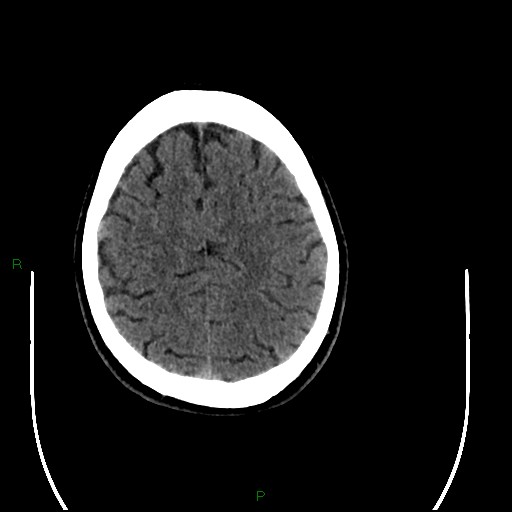 Acute posterior cerebral artery territory infarct (Radiopaedia 79329-92393 Axial non-contrast 86).jpg