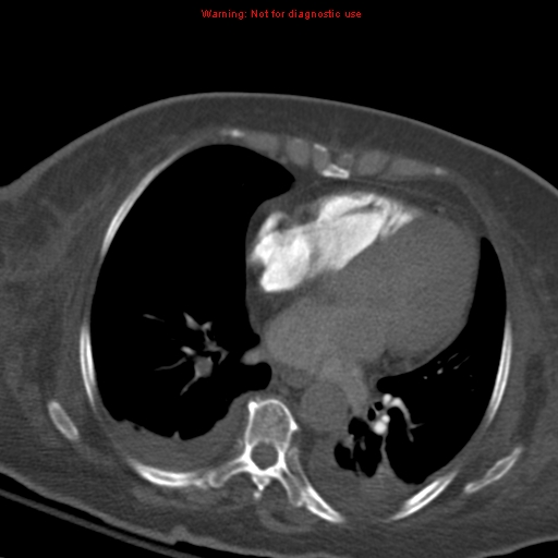 Acute pulmonary embolism (Radiopaedia 13286-13289 Axial C+ CTPA 41).jpg