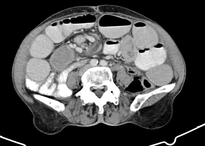 Acute small bowel (ileal) volvulus (Radiopaedia 71740-82139 Axial C+ portal venous phase 126).jpg