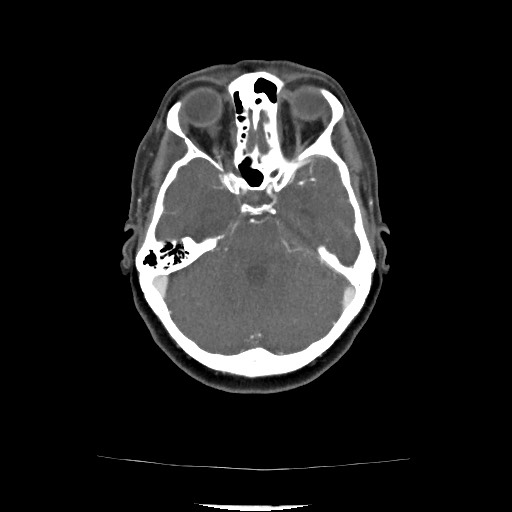 Acute subarachnoid hemorrhage and accessory anterior cerebral artery (Radiopaedia 69231-79009 Axial C+ arterial phase 88).jpg