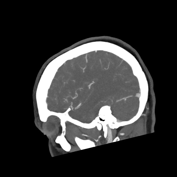 Acute subarachnoid hemorrhage and accessory anterior cerebral artery (Radiopaedia 69231-79009 Sagittal C+ arterial phase 20).jpg