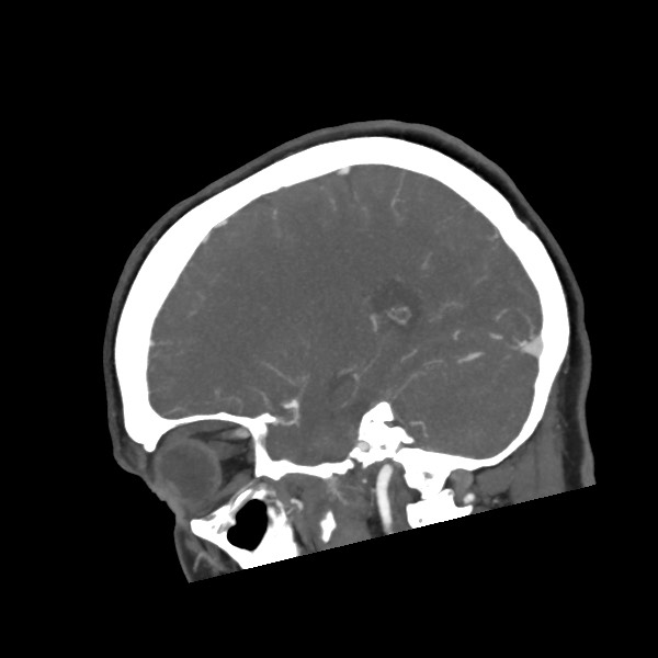 Acute subarachnoid hemorrhage and accessory anterior cerebral artery (Radiopaedia 69231-79009 Sagittal C+ arterial phase 26).jpg