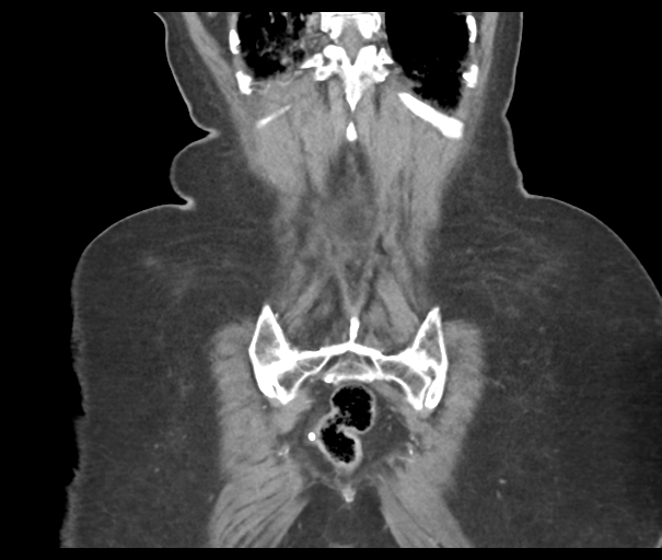 Acute superior mesenteric artery occlusion (Radiopaedia 43926-47418 Coronal C+ portal venous phase 45).png