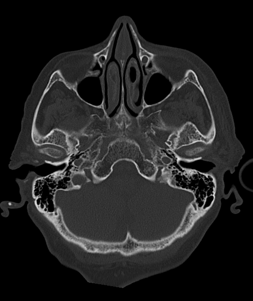 Acute traumatic subdural hematoma (Radiopaedia 82921-97257 Axial bone window 87).jpg