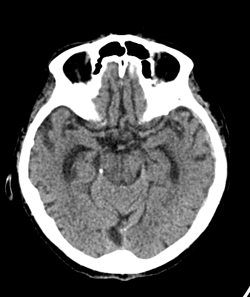 Acute traumatic subdural hematoma (Radiopaedia 82921-97257 Axial non-contrast 41).jpg