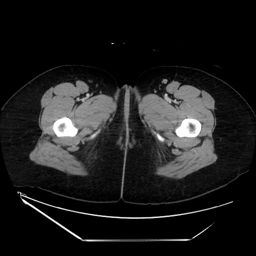 Acute uncomplicated appendicitis (Radiopaedia 73704-84499 Axial C+ portal venous phase 182).jpg