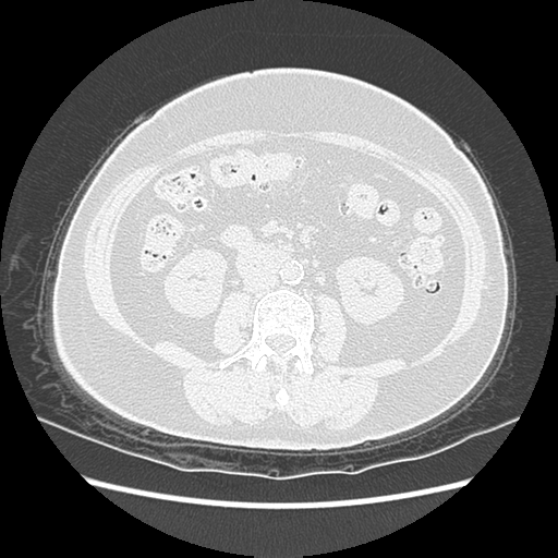 Adenocarcinoma in situ of lung (Radiopaedia 38685-40829 B 283).png