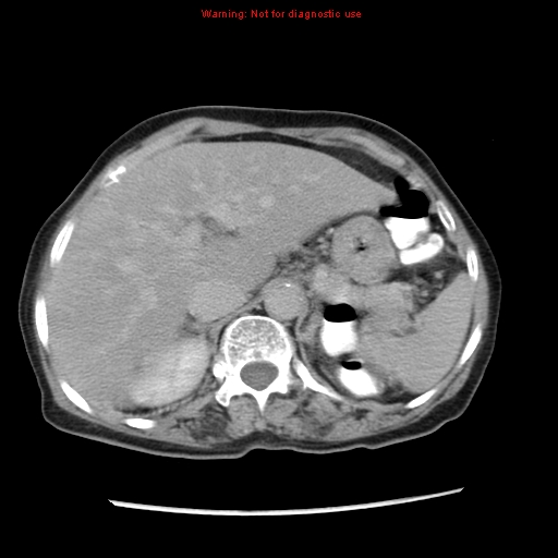 File:Adenocarcinoma of the colon (Radiopaedia 8191-9039 Axial renal excretory phase 6).jpg