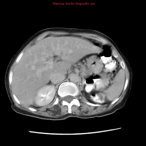 File:Adenocarcinoma of the colon (Radiopaedia 8191-9039 Axial renal excretory phase 8).jpg