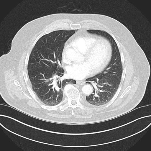 Adenocarcioma of rectum- T1 lesion (Radiopaedia 36921-38547 Axial lung window 33).png