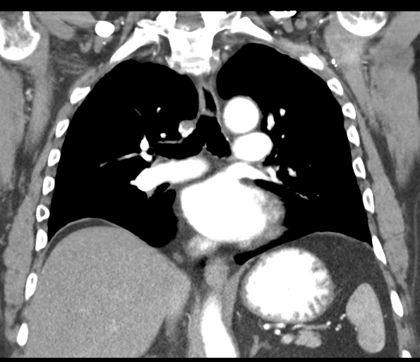 Adenocarcioma of rectum- T1 lesion (Radiopaedia 36921-38547 Coronal C+ arterial phase 36).png