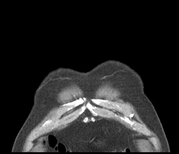 Adenocarcioma of rectum- T1 lesion (Radiopaedia 36921-38547 Coronal C+ arterial phase 7).png