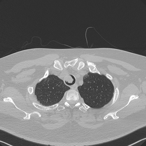 Adenoid cystic carcinoma of the trachea (Radiopaedia 49042-54137 Axial lung window 51).jpg