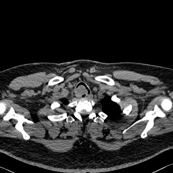 File:Adenoid cystic carcinoma of the trachea (Radiopaedia 49042-54137 Axial non-contrast 23).jpg