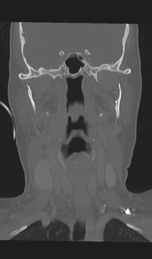 Adenoid cystic tumor of palate (Radiopaedia 46980-51518 Coronal bone window 34).png