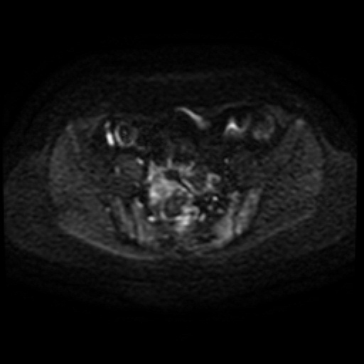 Adenoma malignum of cervix (Radiopaedia 66441-75705 Axial DWI 55).jpg