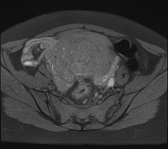 File:Adenomyosis - ovarian endometriomas (Radiopaedia 67031-76350 Axial T1 fat sat 10).jpg
