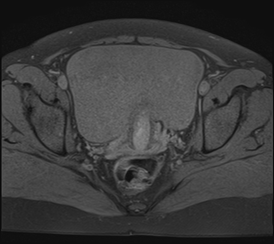 File:Adenomyosis - ovarian endometriomas (Radiopaedia 67031-76350 Axial T1 fat sat 18).jpg