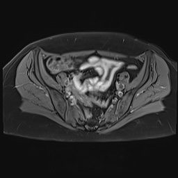 File:Adenomyosis and endometriotic cysts (Radiopaedia 82300-96367 Axial T1 C+ fat sat 21).jpg