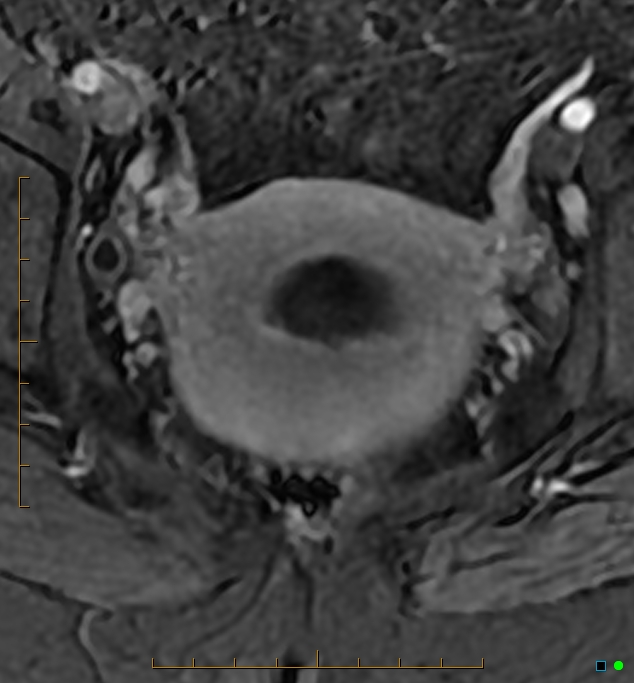 Adenomyosis uterus with hematometra (Radiopaedia 45779-50011 Axial T1 C+ fat sat 40).jpg