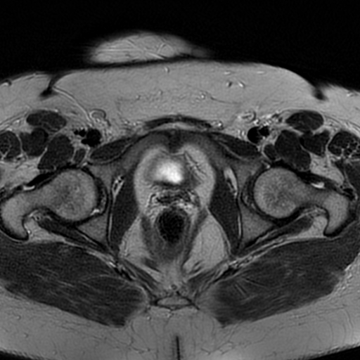 File:Adenomyosis within a didelphys uterus (Radiopaedia 70175-80215 Axial T2 29).jpg