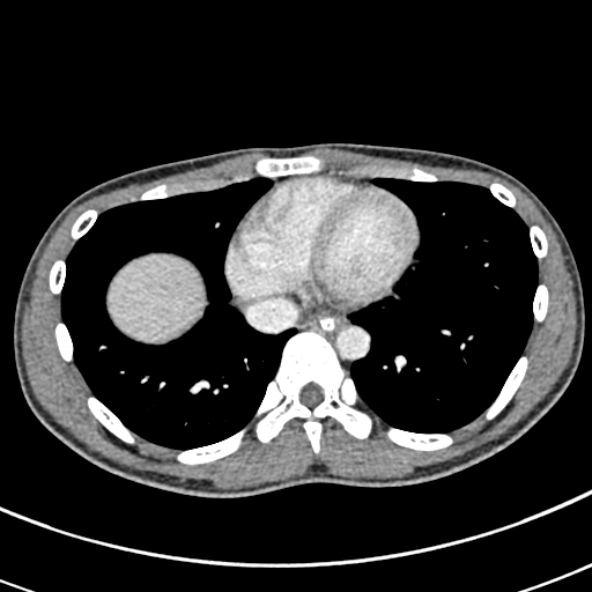 Adhesional small bowel obstruction (Radiopaedia 52107-57980 Axial C+ portal venous phase 2).jpg