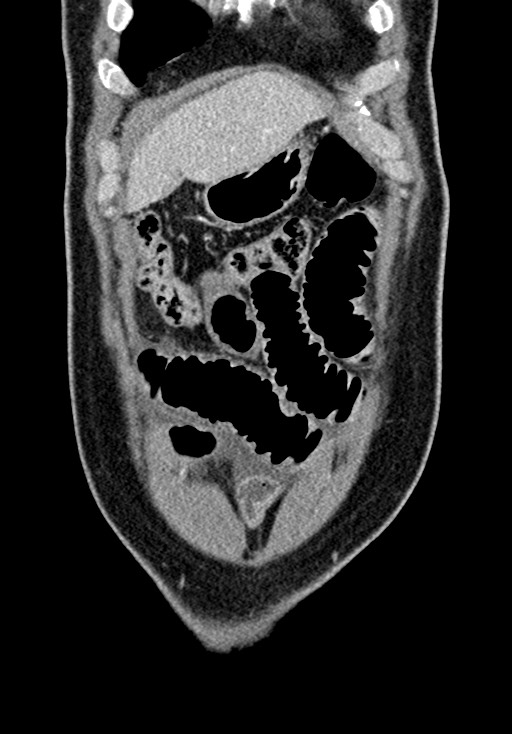Adhesional small bowel obstruction (Radiopaedia 58900-66131 Coronal C+ portal venous phase 74).jpg
