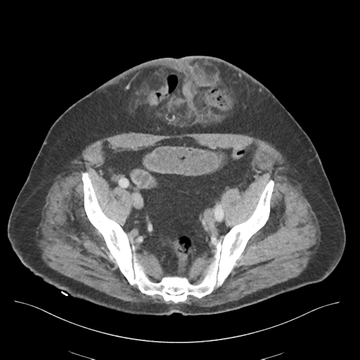 File:Adhesions within abdominal wall hernia (Radiopaedia 58283-65394 Axial C+ portal venous phase 68).png