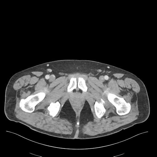 Adhesions within abdominal wall hernia (Radiopaedia 58283-65394 Axial C+ portal venous phase 86).png