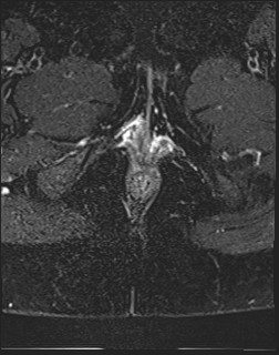 File:Adnexal multilocular cyst (O-RADS US 3- O-RADS MRI 3) (Radiopaedia 87426-103754 Axial T2 fat sat 30).jpg