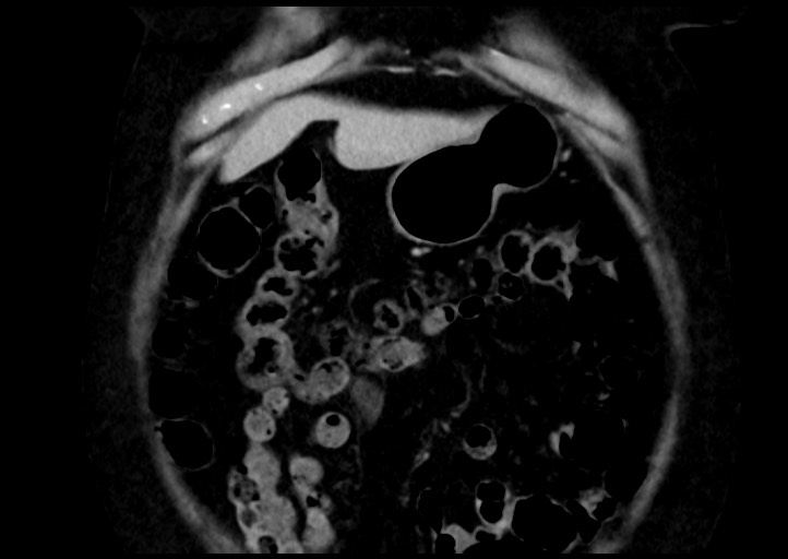 File:Adrenal cortical carcinoma (Radiopaedia 64017-72769 Coronal C+ portal venous phase 9).jpg
