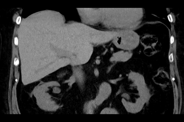 Adrenal cortical carcinoma (Radiopaedia 64017-72769 Coronal non-contrast 27).jpg