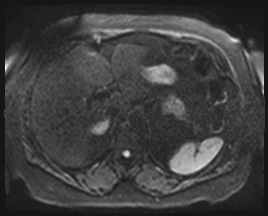 Adrenal cortical carcinoma (Radiopaedia 64017-72770 Axial DWI 53).jpg
