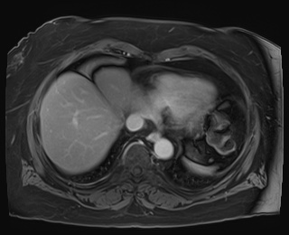 Adrenal cortical carcinoma (Radiopaedia 64017-72770 K 2).jpg