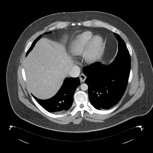 File:Adrenal cyst (Radiopaedia 45625-49776 Axial C+ portal venous phase 12).png