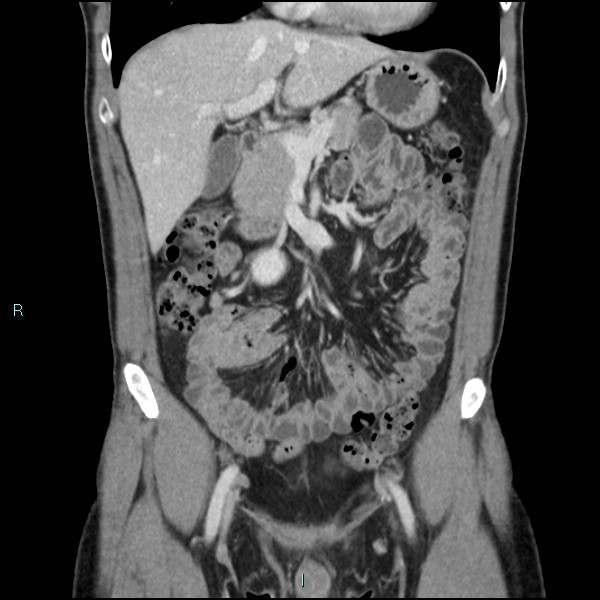 Adrenal cystic lymphangioma (Radiopaedia 83161-97534 Coronal C+ portal venous phase 27).jpg