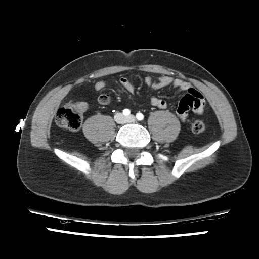 Adrenal gland trauma (Radiopaedia 81351-95078 Axial Dual bolus trauma C+ 92).jpg