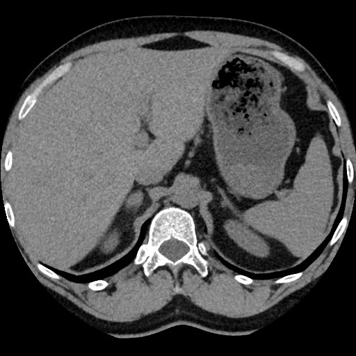 File:Adrenal gland trauma (Radiopaedia 81351-95079 Axial non-contrast 27).jpg