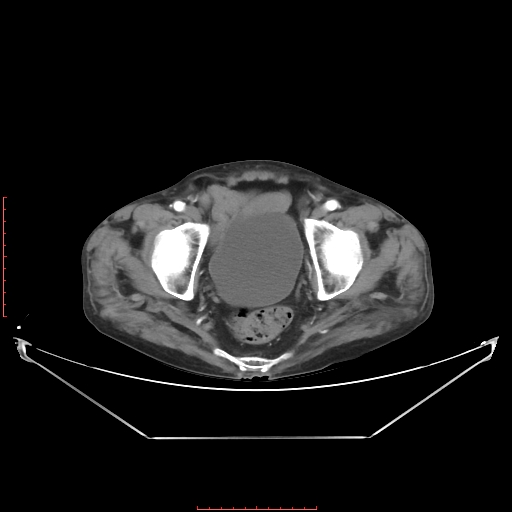 Adrenal hemangioma (Radiopaedia 68923-78668 Axial C+ arterial phase 66).jpg