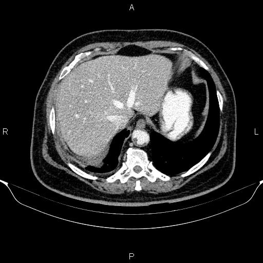 Adrenal hemorrhage (Radiopaedia 62622-70916 Axial C+ portal venous phase 21).jpg