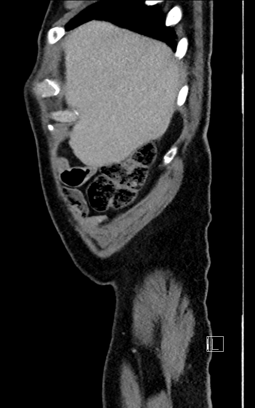Adrenal lymphoma (Radiopaedia 73730-84529 Sagittal C+ portal venous phase 10).jpg