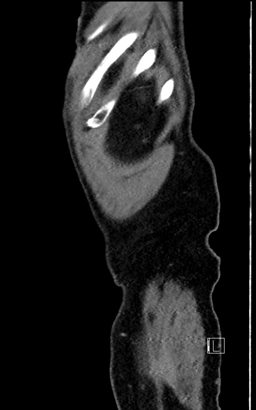 Adrenal lymphoma (Radiopaedia 73730-84529 Sagittal C+ portal venous phase 108).jpg