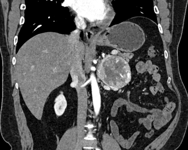 Adrenal metastases (Radiopaedia 73082-83791 Coronal C+ arterial phase 24).jpg