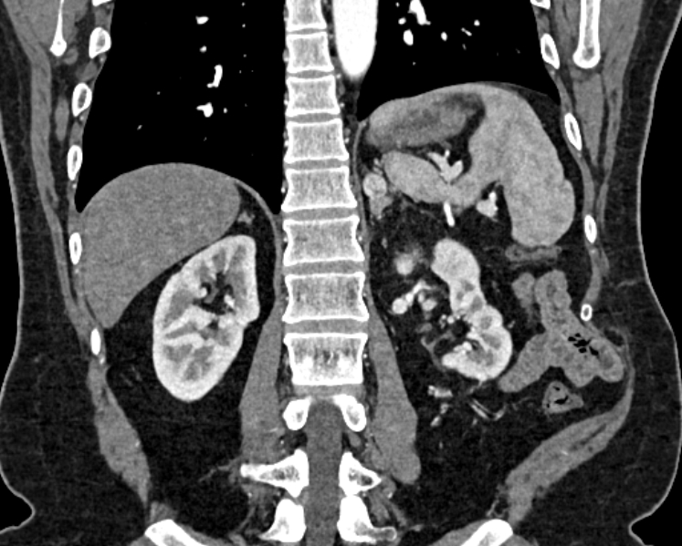 Adrenal metastases (Radiopaedia 73082-83791 Coronal C+ arterial phase 53).jpg