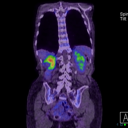 File:Adrenal metastasis from small cell lung cancer (Radiopaedia 19133-19109 Coronal 26).jpg